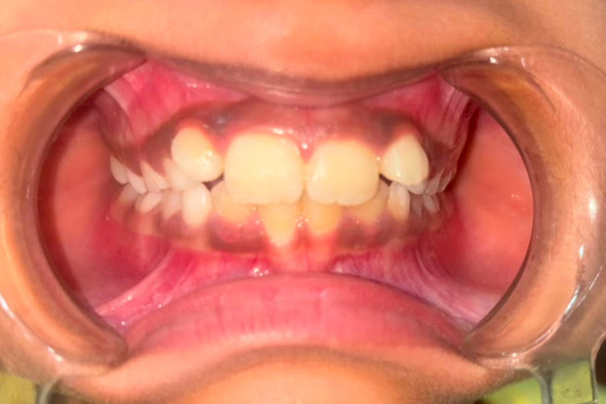 Before Treatment